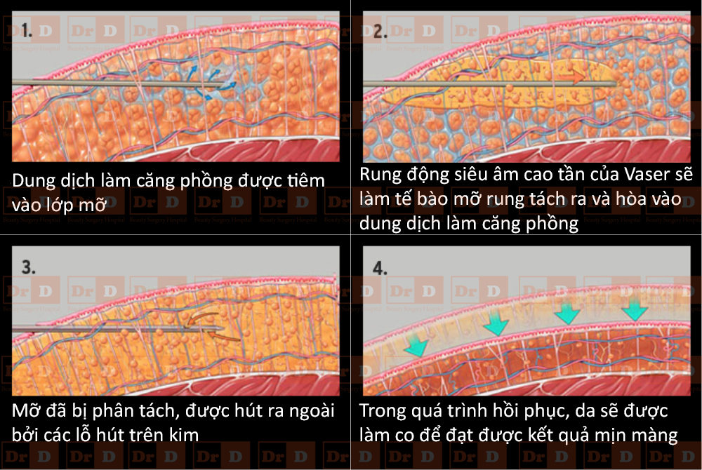 Công nghệ hút mỡ Vaser Lipo