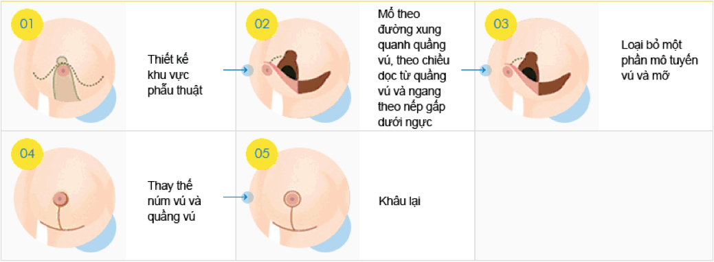 Quy trình nâng ngực sa trễ phổ biến