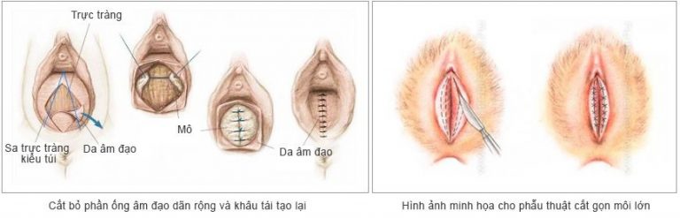 Thu nhỉ môi lớn cần được thực hiện theo quy trình chuẩn