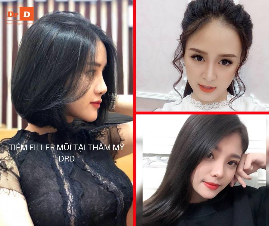 Tiêm filler tạo hình tạo đường nét gương mặt hài hòa hơn