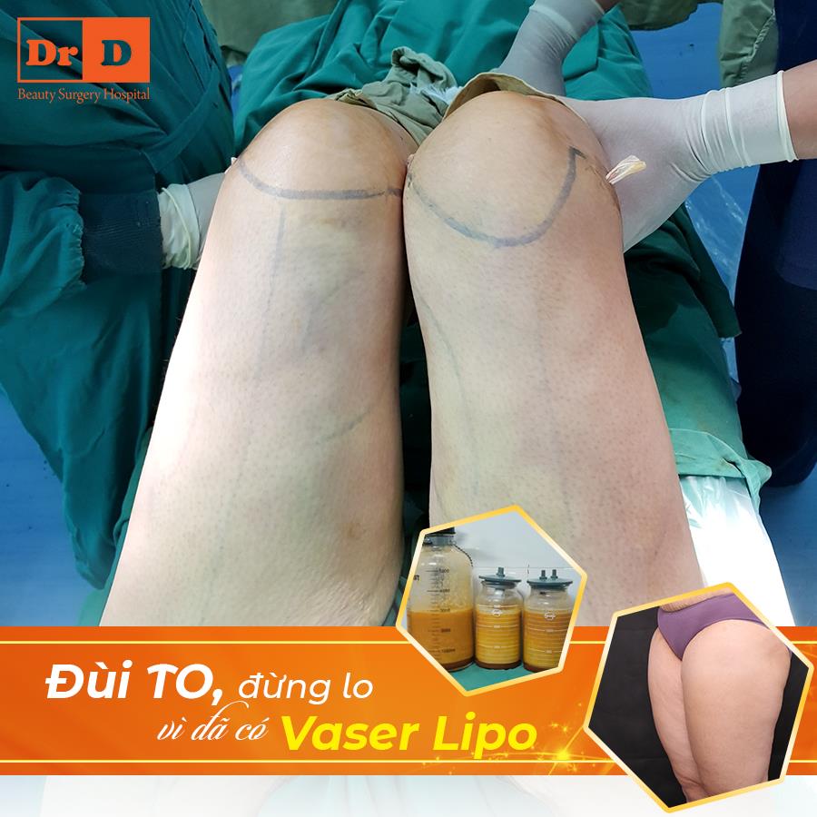 Vaser Lipo - Loại bỏ triệt để mỡ thừa trên cơ thể