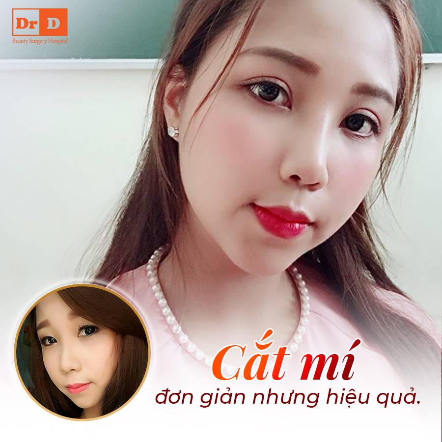 Cắt mí giúp khách hàng sở hữu đôi mắt tinh anh