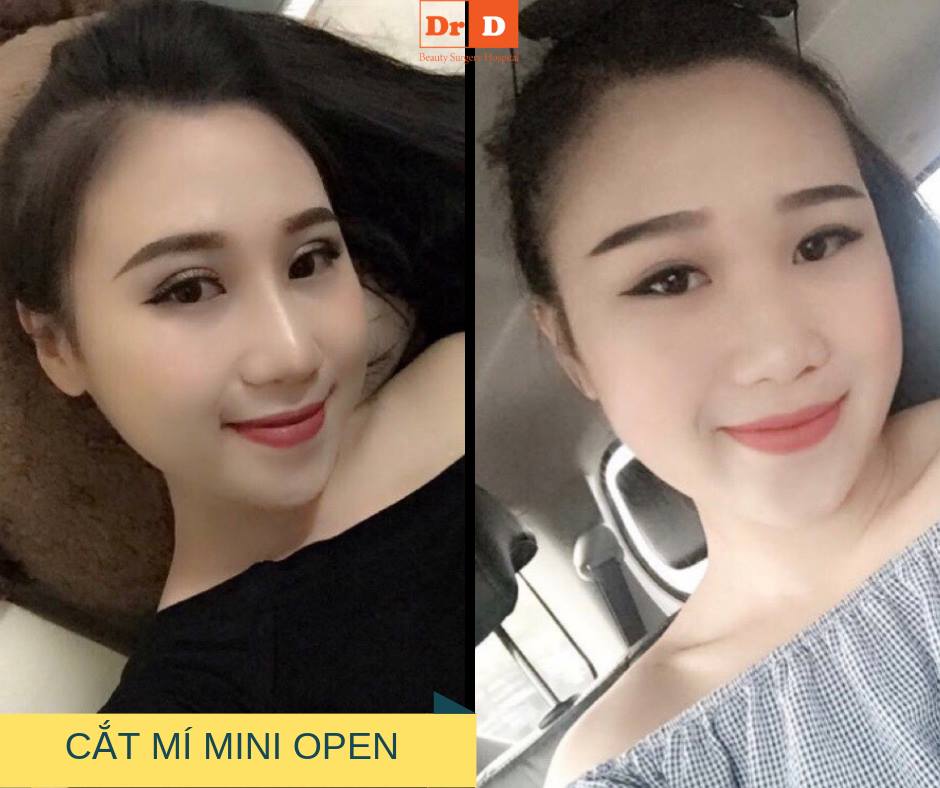 Cắt tạo mí mắt Mini Open sẽ thay thế phương pháp bấm mí trong tương lai