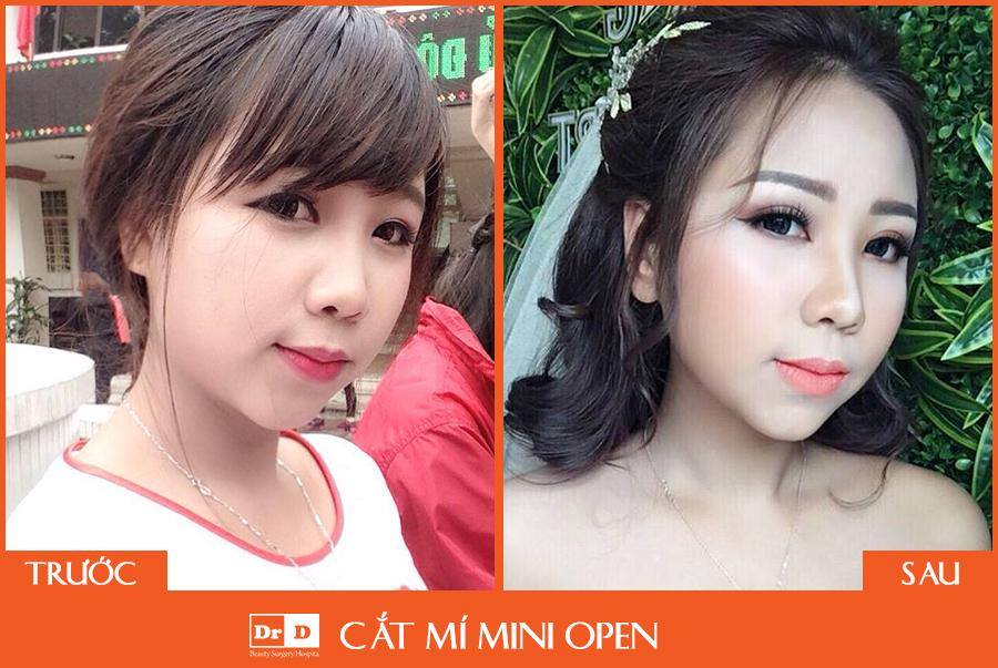 Hình ảnh khách hàng thực hiện cắt mí mắt Mini Open tại Thẩm mỹ DrD