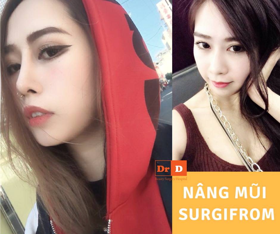 Mũi đẹp chuẩn hiện đại sau khi nâng mũi chất liệu sụn Surgiform