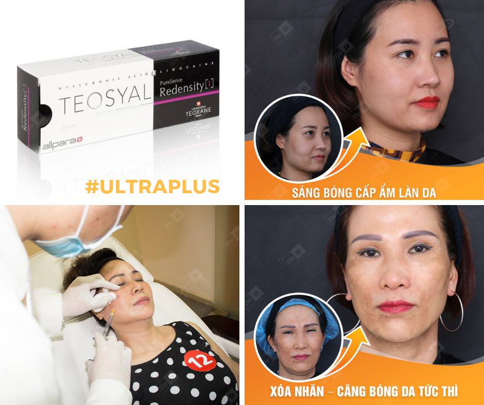 Nâng cơ UltraPlus là dịch vụ thu hút khách hàng nhất tại Thẩm mỹ DrD