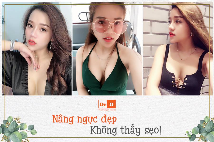 Nâng ngực giúp chị em sở hữu vòng 1 đầy đặn, quyến rũ