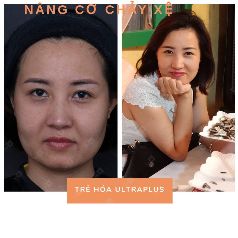 Nâng cơ UltraPlus mang lại hiệu quả cho làn da lão hóa