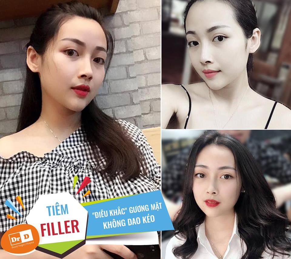 Chất lượng Filler phải đảm bảo an toàn, rõ nguồn gốc