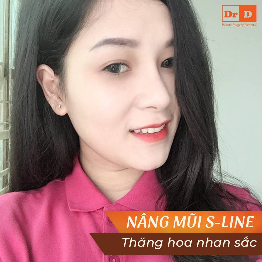 Nâng mũi S Line – Thăng hoa nhan sắc - Mũi đẹp dài lâu