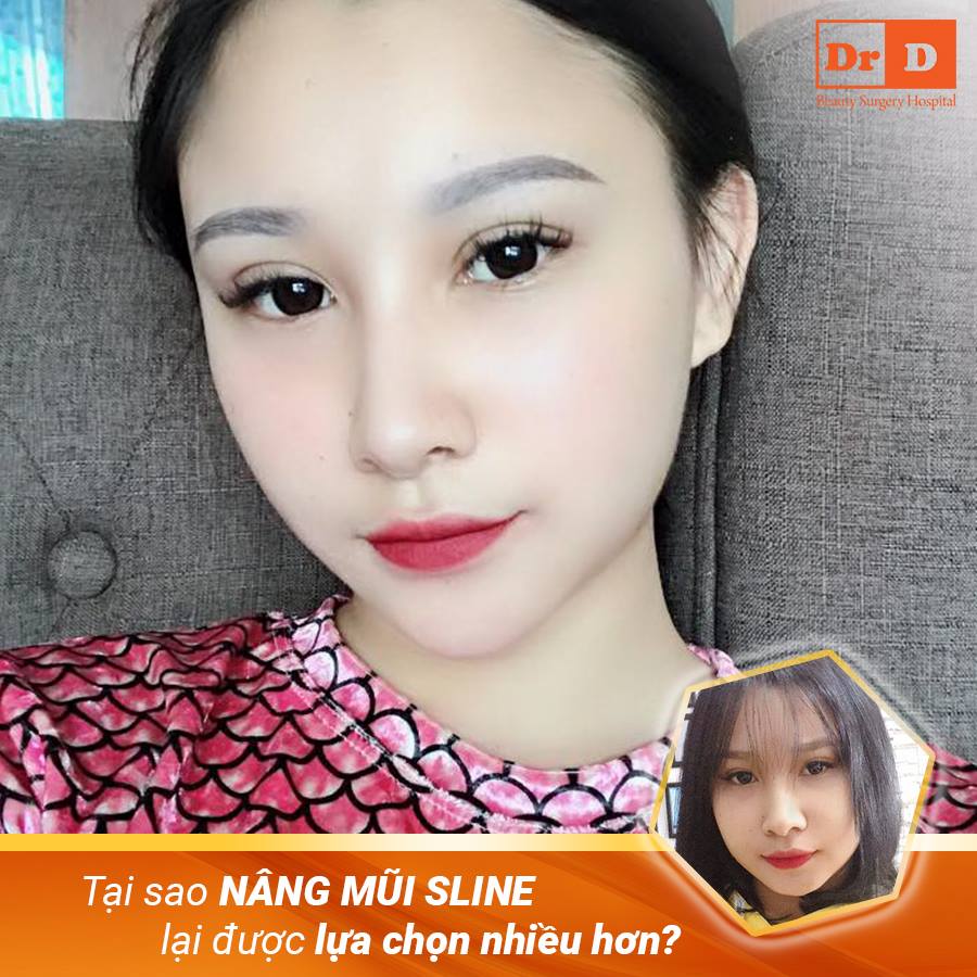 Dáng mũi S - Line đẹp tự nhiên, chuẩn tỷ lệ vàng