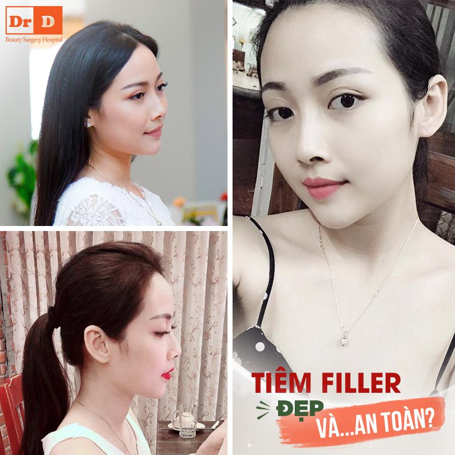 Tay nghề bác sĩ và chất liệu Filler quyết định sự an toàn và hiệu quả