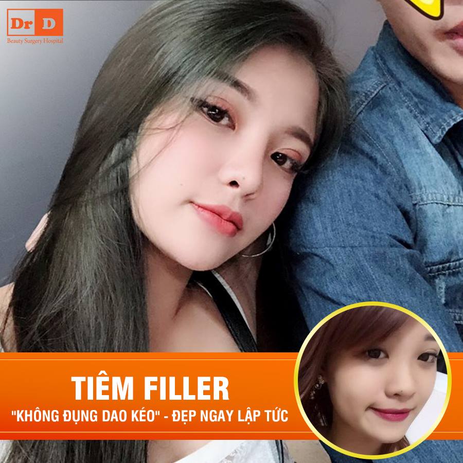 Tiêm Filler - Đẹp ngay tức thì