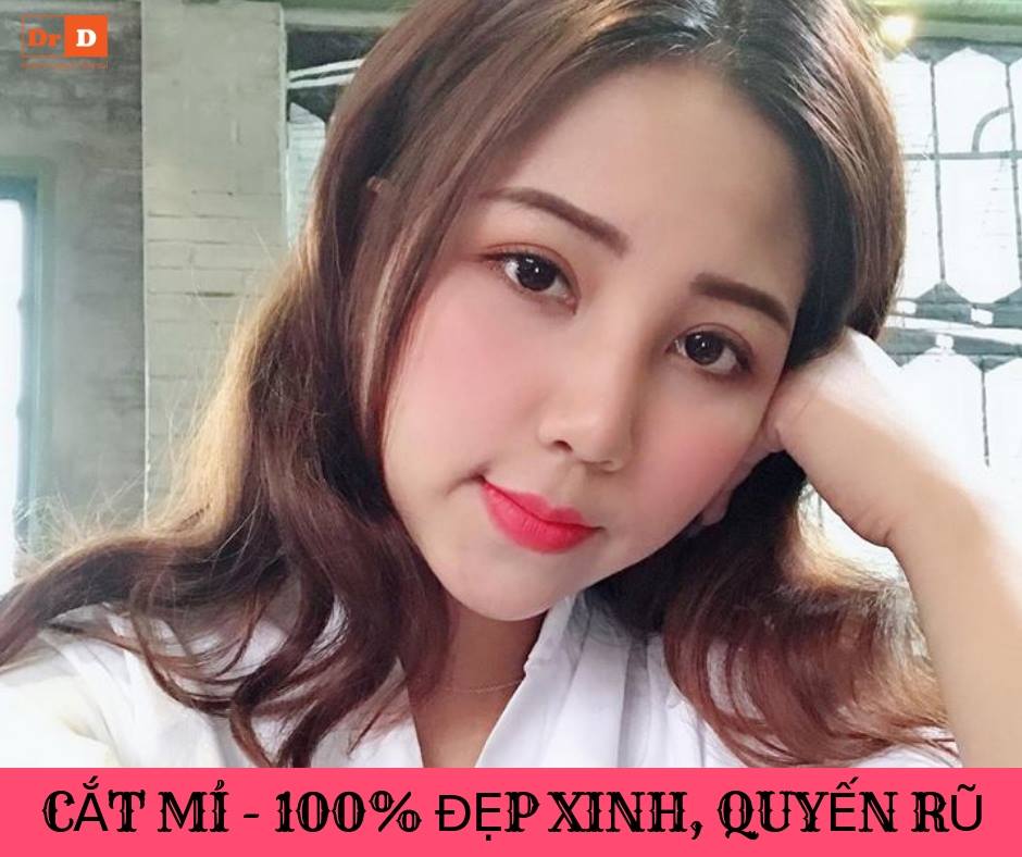 Cắt mí sau 5 - 7 ngày là hết sưng