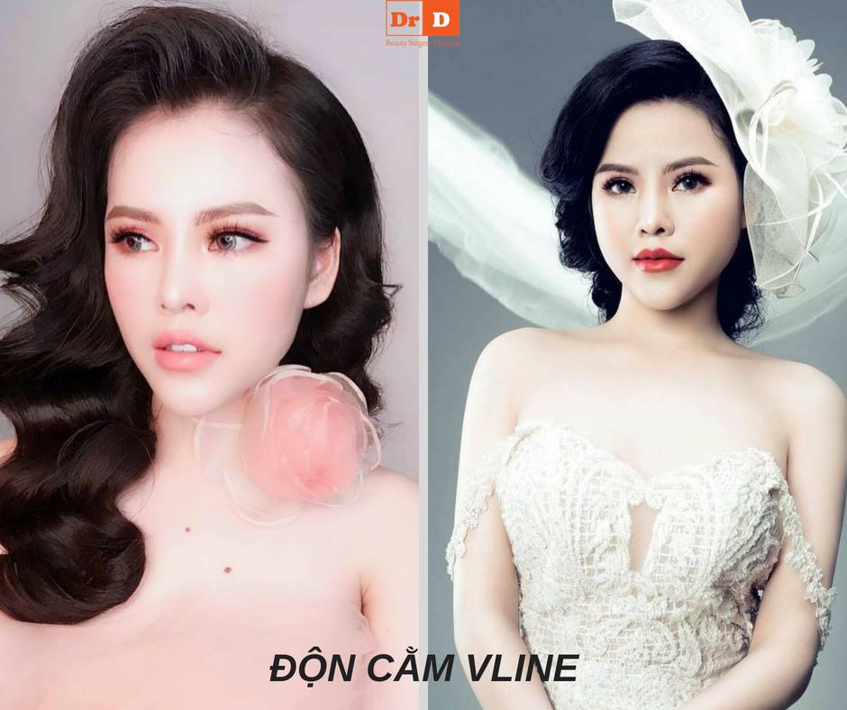 Độn cằm V-Line được giới trẻ mê mẩn