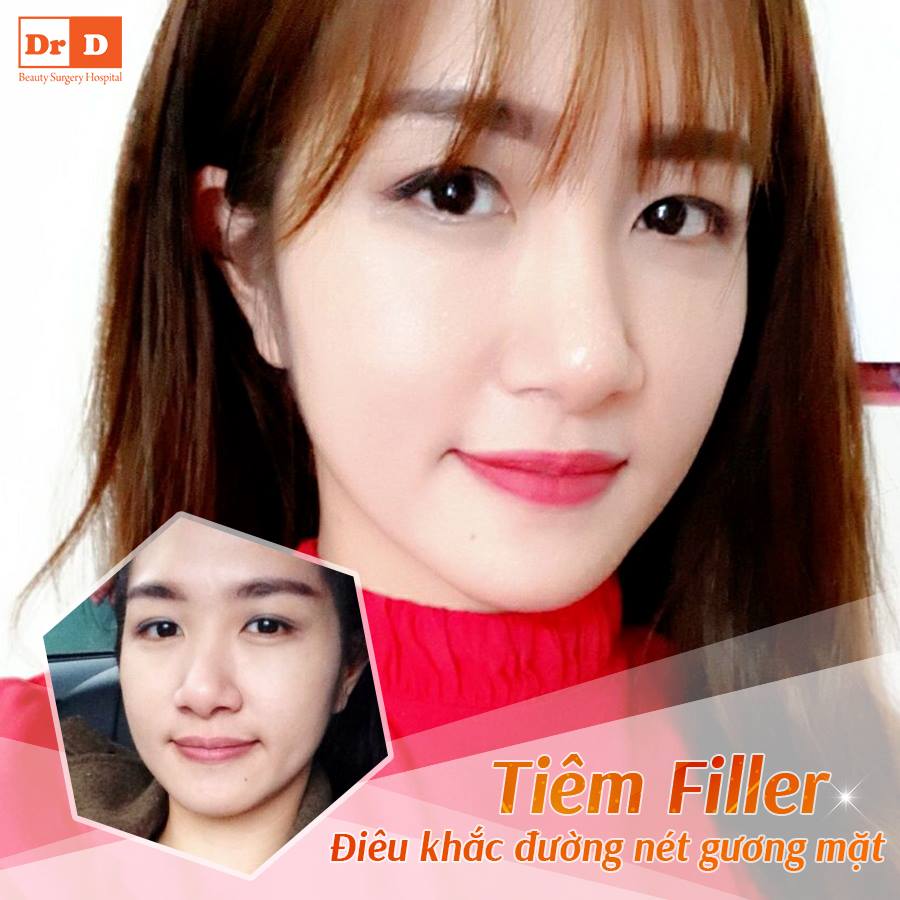 Filler giúp mọi người điêu khắc đường nét gương mặt hài hòa hơn