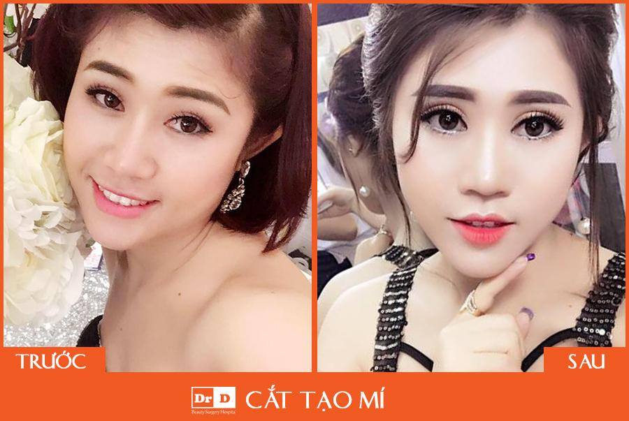 Đôi mắt tinh anh hơn sau khi phẫu thuật cắt mí mắt