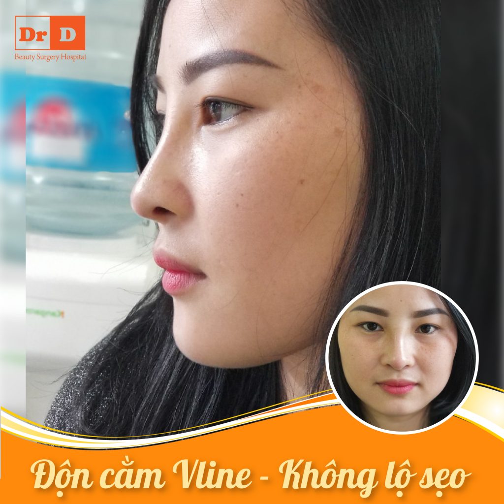 Độn cằm Vline - Không lộ sẹo thẩm mỹ sau phẫu thuật