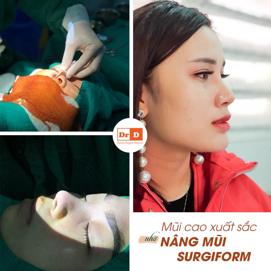 Nâng mũi Surgiform đòi hỏi tay nghề bác sĩ phải cao