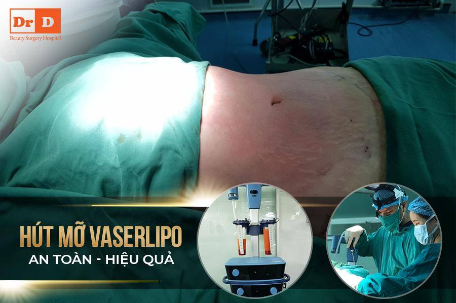 Vaser Lipo triệt tiêu hiệu quả lượng mỡ thừa của cơ thể