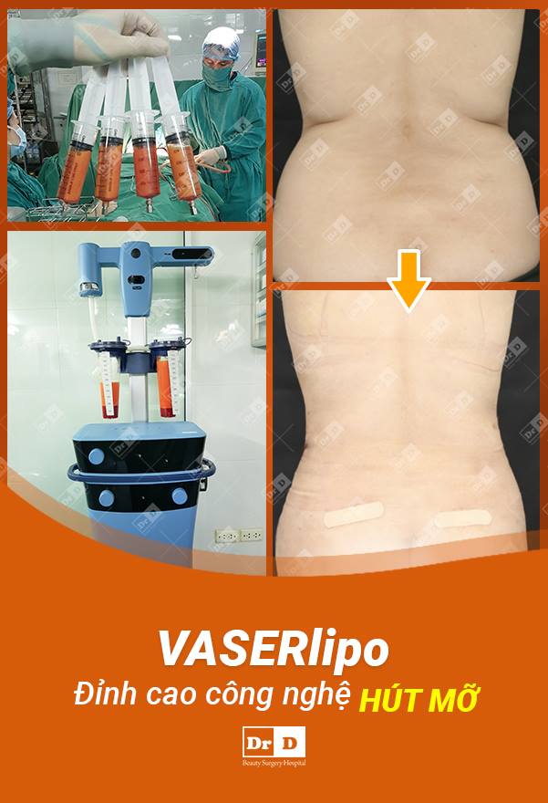 Hút mỡ Vaser Lipo đã được FDA Hoa Kỳ chứng nhận về độ an toàn