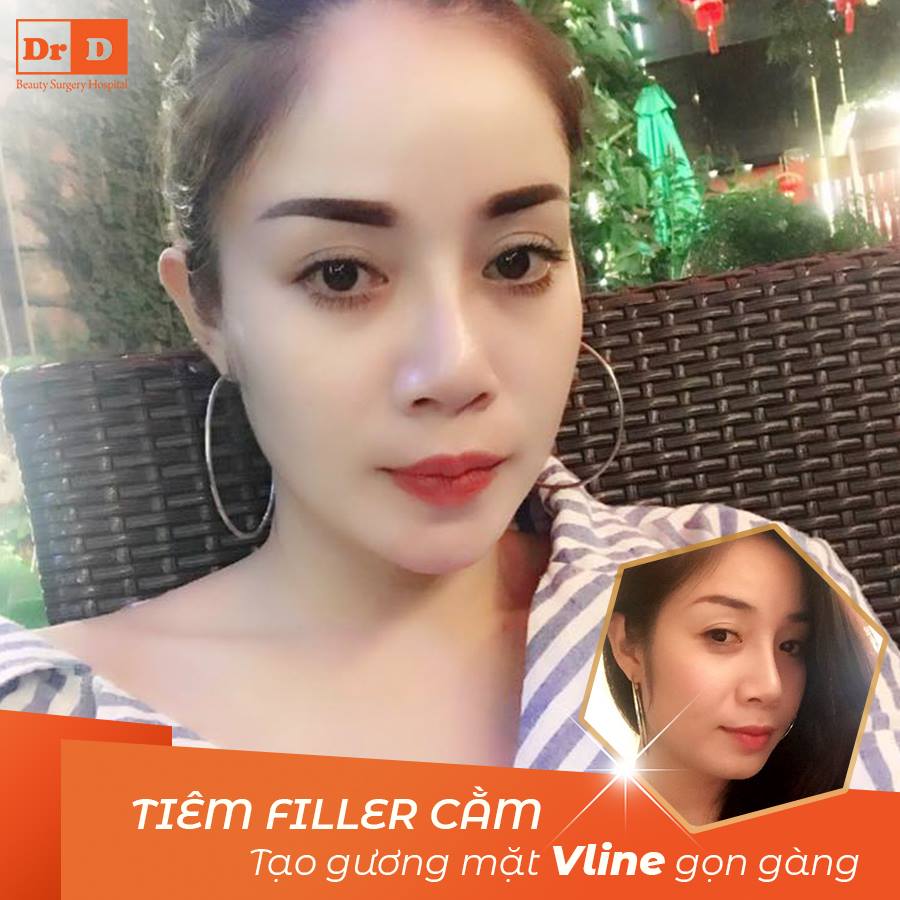 Tiêm Filler cằm tạo hình  gương mặt thon gọn