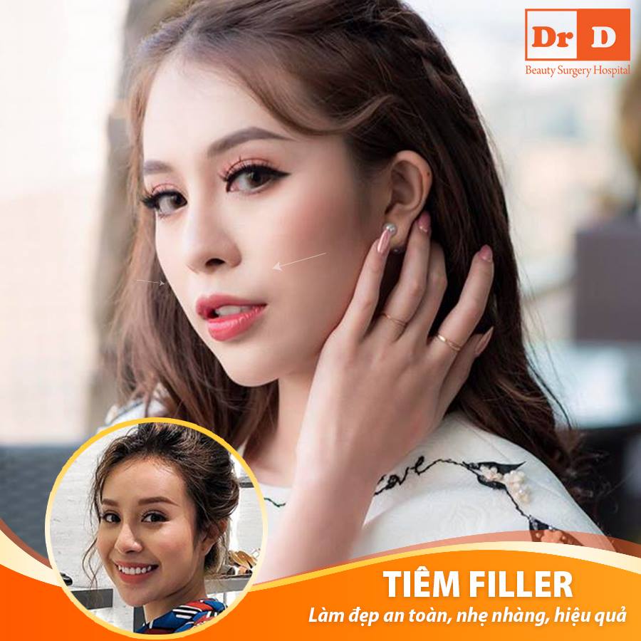 Tiêm Filler làm đẹp an toàn dành cho chị em nghiện "thẩm mỹ"