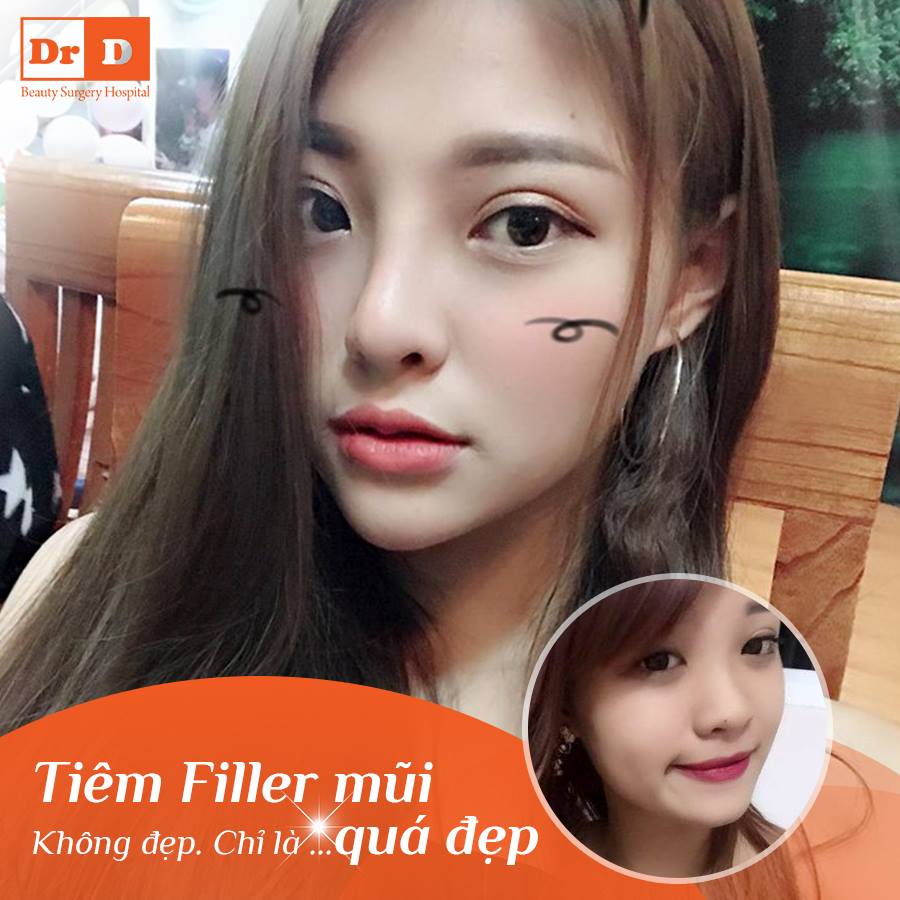 Tiêm Filler - Trào lưu làm đẹp chưa bao giờ hết nhiệt