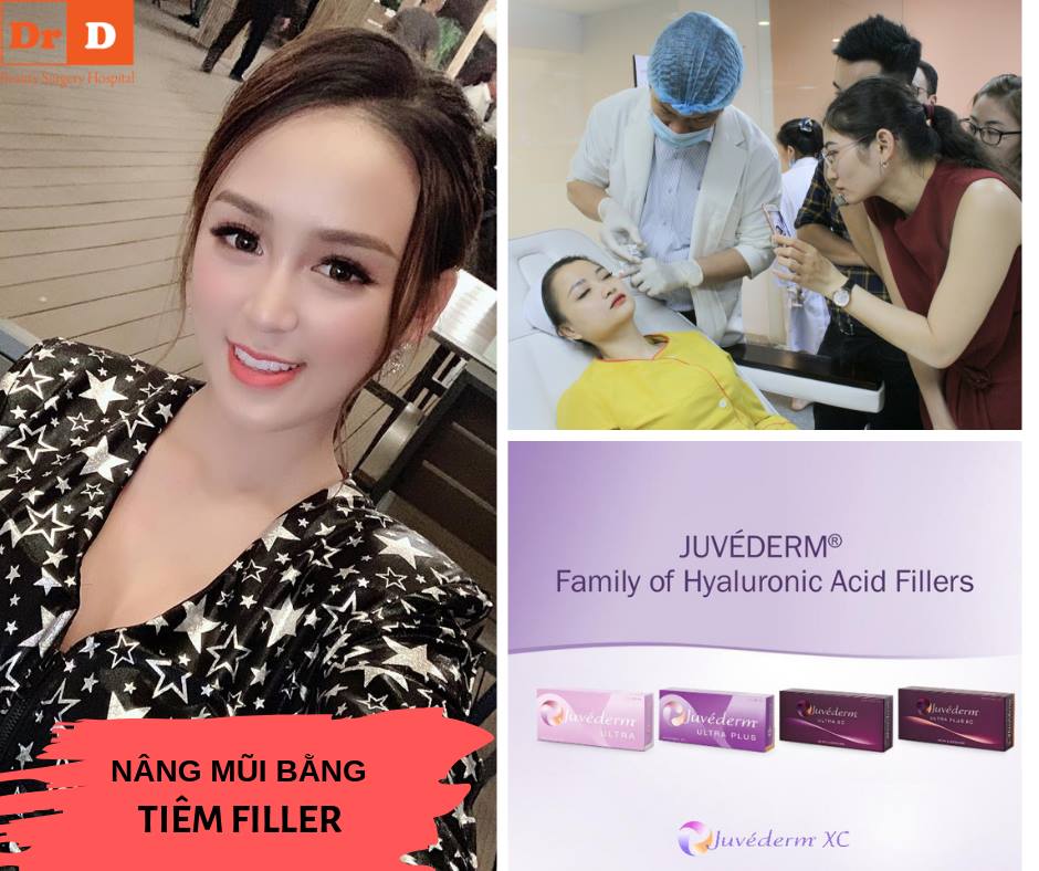 Tiêm Filler chỉ duy trì kết quả được khoảng 2 năm