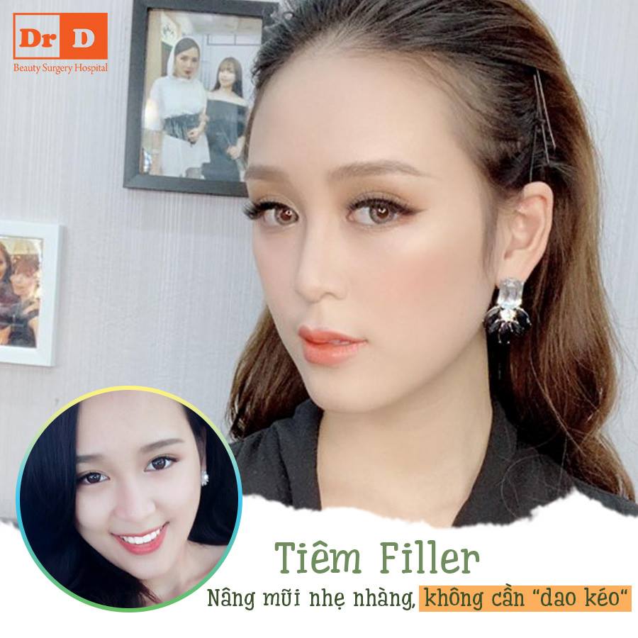 Tiêm Filler dễ dàng sở hữu dáng mũi đẹp tự nhiên