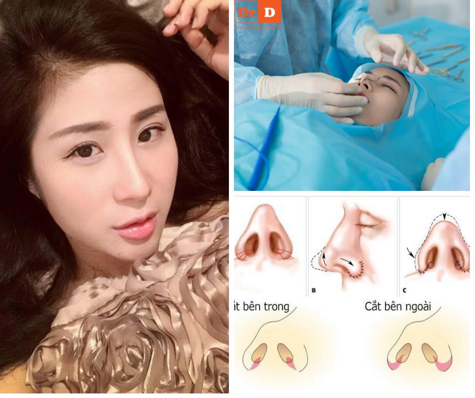 Phương pháp nâng mũi quyết định tính thẩm mỹ sau cùng