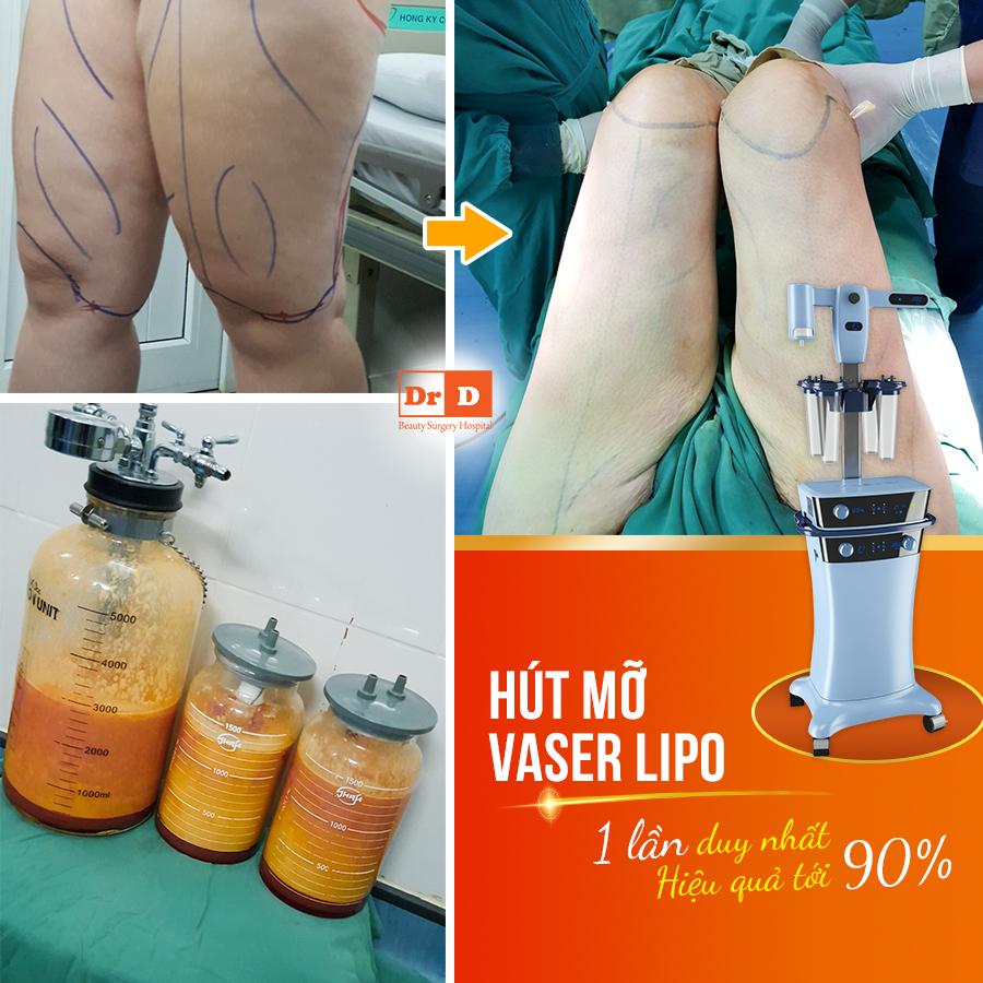 Cùng DrD đi tìm câu trả lời cho câu hỏi “Hút mỡ Vaser Lipo có hiệu quả không?”